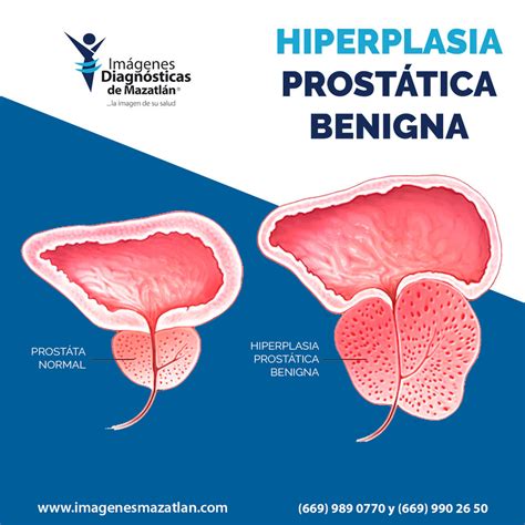hiperplasia prostatica benigna